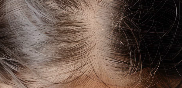 Hormonal Life-Stage Thinning
