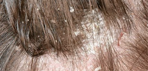 Excess Oil & Scalp Imbalance