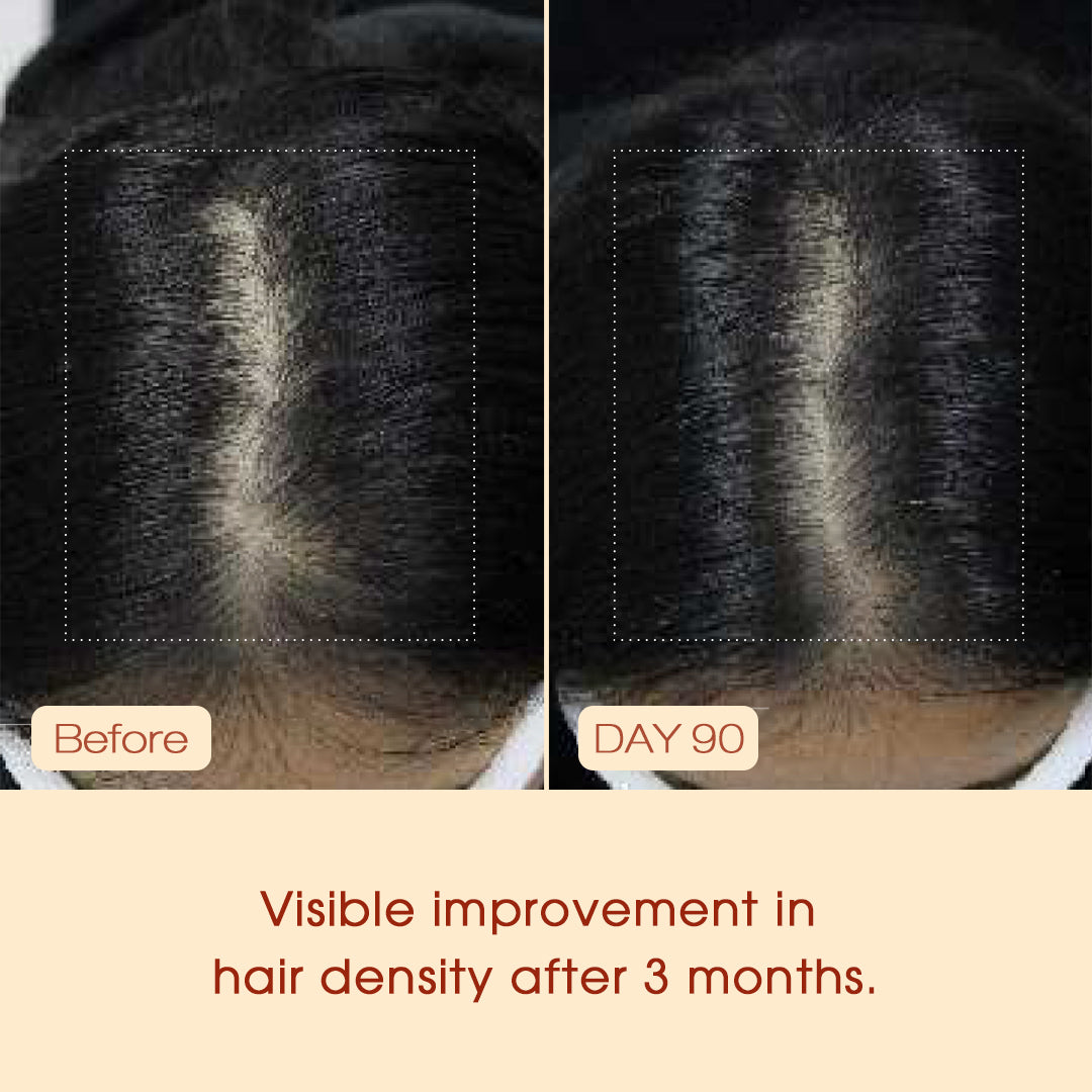 Reduce hair fall by 86.67% with Beaver's 50ml anti-hair loss serum. Powered by patented Schizophyllan & 6 herbs. Natural, safe for pregnancy. Shop now!